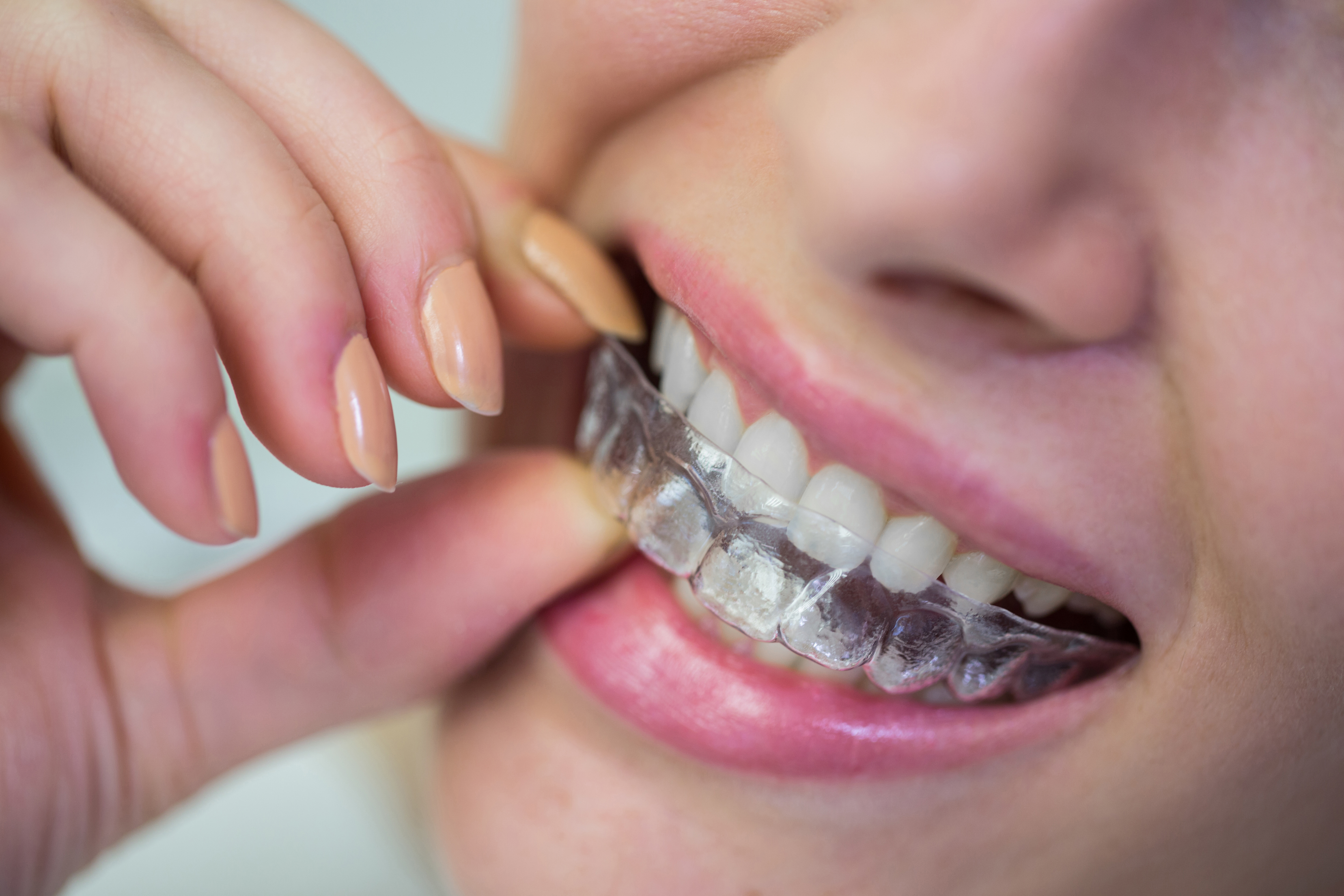 best invisalign treatment in india